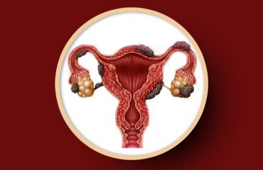 Endometriosis & Infertility