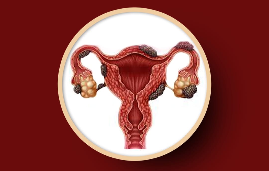 Endometriosis & Infertility